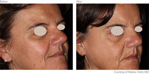 BeforeAfter1-Non-Ablative-Courtesy-of-Matteo-Tretti-Clementoni-M.D.