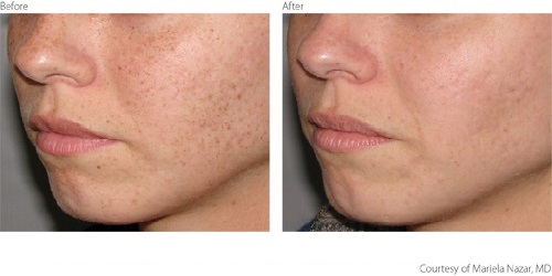 BeforeAfter1-Pigmentation-Freckles-Courtesy-of-Mariela-Nazar-M.D.Updated