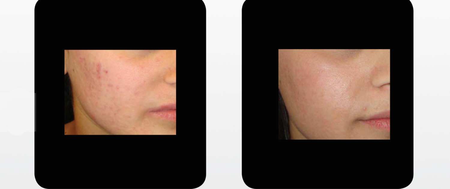 trattamento laser per acne