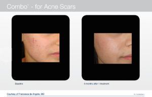 trattamento laser per acne