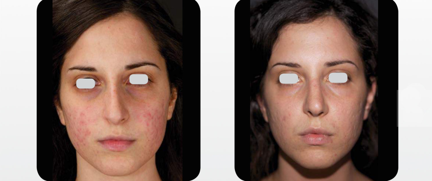 trattamento laser per acne