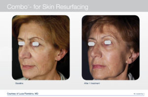trattamento laser