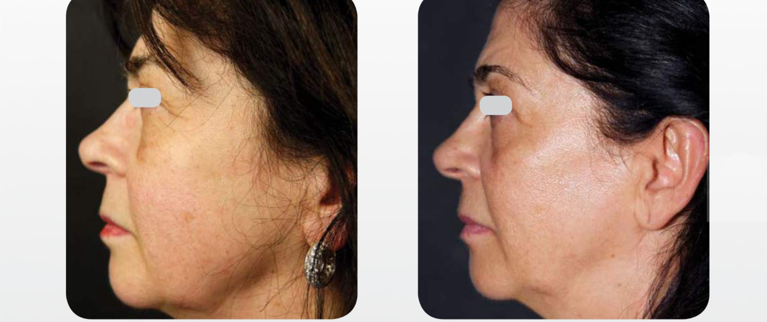 trattamento laser per viso