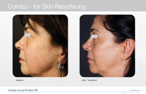 trattamento laser per viso