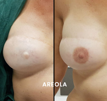 areola_opt