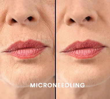 microneedling_opt