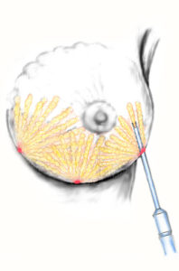 lipofilling seno iniezione grasso