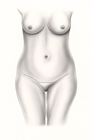 Addominoplastica-1