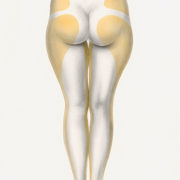 Liposcultura