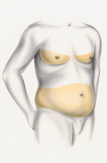 Liposcultura