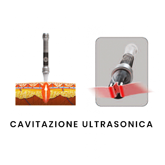 cavitazione ultrasonica