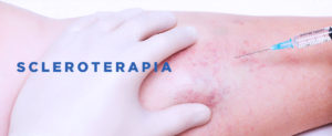 scleroterapia