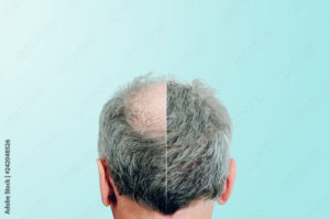 trapianto capelli fue