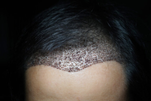 trapianto capelli fue donne