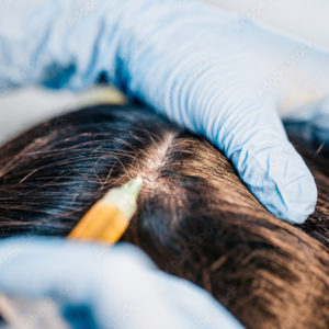 rimedio fue caduta capelli