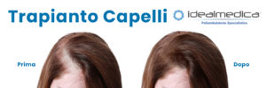 trapianto capelli fue donne