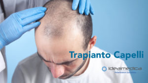 trapianto capelli uomo