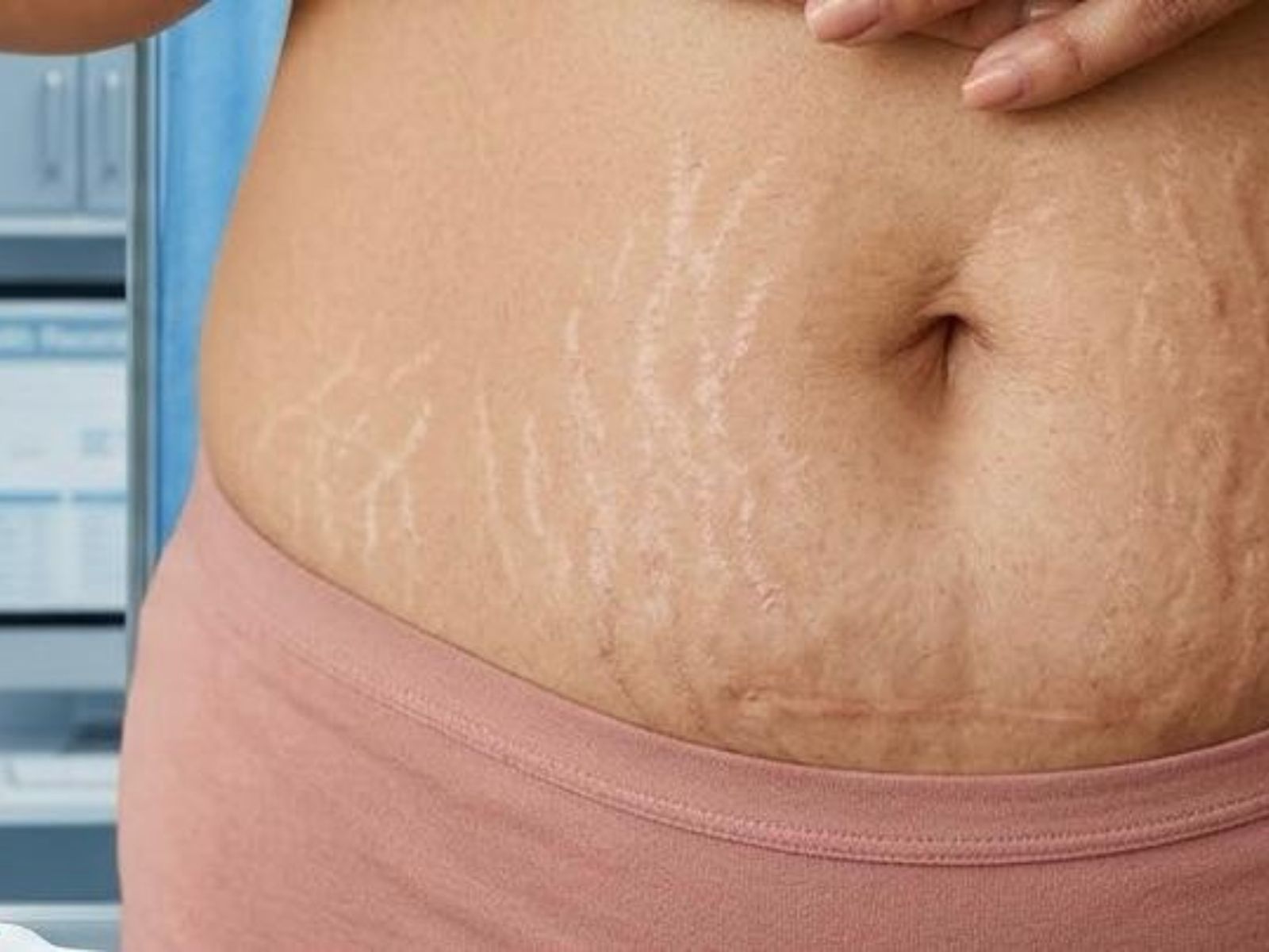 Smagliature — trattamenti di medicina estetica in Idealmedica.