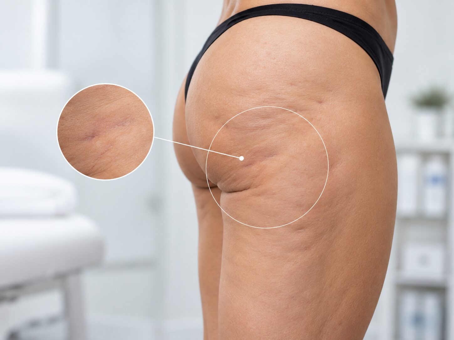Inestetismi post liposuzione — trattamenti di medicina estetica in Idealmedica.